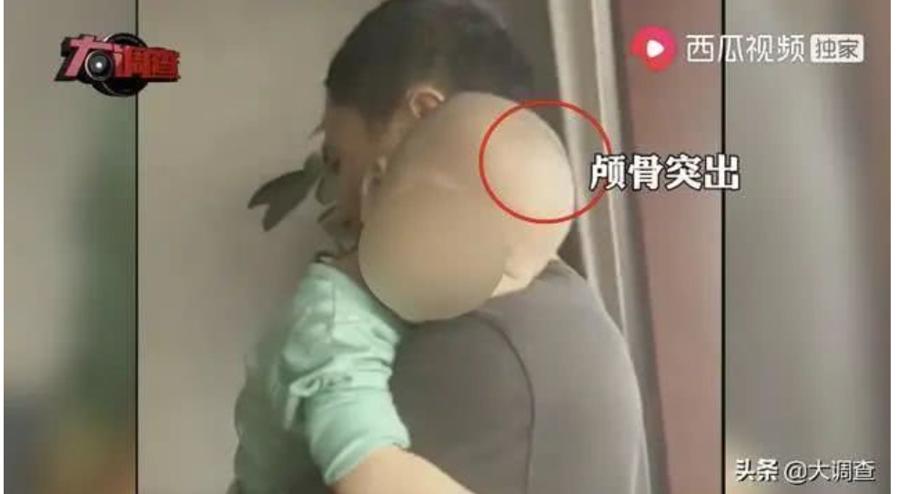 【最新】湖南郴州再现“大头娃娃”官方:未发现医生参与假奶粉事件
