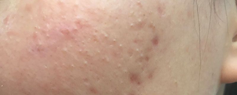 脸上的痘痘反反复复，到底该如何养成好皮肤？
