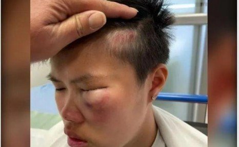 一名9年级14岁华裔女孩在加拿大学校被打晕